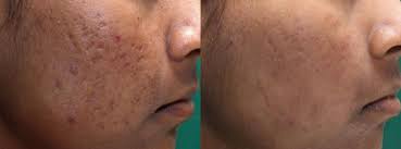 acne scar treatment vancouver surrey