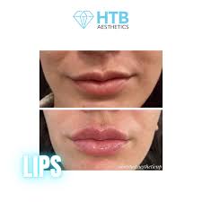 lip enhancement htb aesthetics