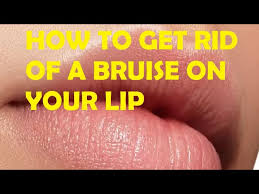 how to get rid of a bruise on your lip