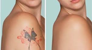 Possibly one of the worst things you can do is try to remove a tattoo on your own. Tattoo Removal Methods