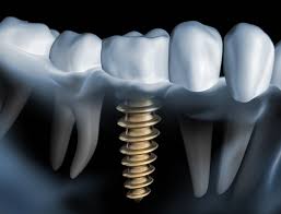 Dental implants - choose the solution that suits you