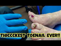 debridement of the thickest toenails
