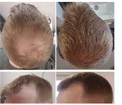 does finasteride regrow hair expert