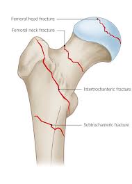 hip fractures knowledge amboss