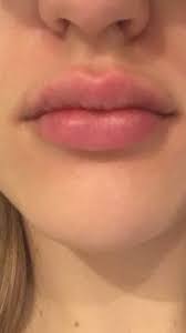 ps and lumps after lip injections