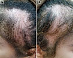 trichotillomania and traction alopecia