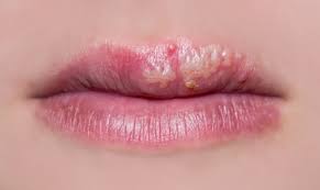 what causes cold sores embarring