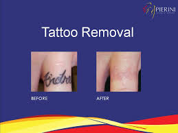 laser tattoo removal miami d