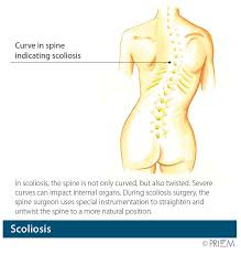 scoliosis spinal deformity swift