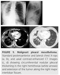 Ros pr, yuschok tj, buck jl, et al. Diagnostic Imaging And Workup Of Malignant Pleural Mesothelioma