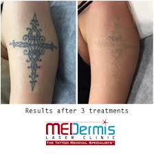 The laser that is being used is also a huge factor in how many. Arms Hands Laser Tattoo Removal Before After Results Medermis