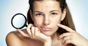how to remove pimple marks 12 effective