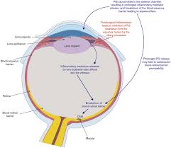 cystoid macular edema to