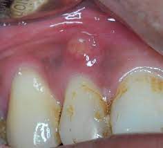 Simply put, wadia describes a gum boil as, 'an abscess that develops on the gums. Family S Campus Parents Of Children Aged 6 Or Below Oral Problems Tooth Abscess