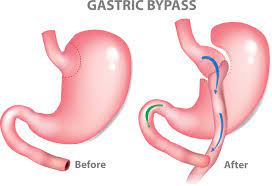 gaining weight after gastric byp