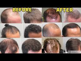 minoxidil users for treating hair loss