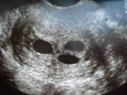 5 weeks of pregnancy is when most women start to come terms with accepting their pregnancy and begin to prepare themselves for the numerous women who are pregnant with twins or multiple babies tend to have stronger symptoms as a result of an extensive hormone boost by the presence of. Triplet Ultrasounds Ultrasound Pictures Triplets Triplet Babies