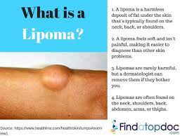 what is lipoma causes lipoma removal