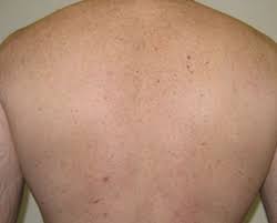 laser hair removal glasgow pain free