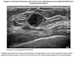 This is one type of biopsy for lumps or abnormalities that breast cancer occurs in both men and women, but it is about 100 times more likely to affect women. Recent Comprehensive Review On The Role Of Ultrasound In Breast Cancer Management Leaders In Pharmaceutical Business Intelligence Lpbi Group