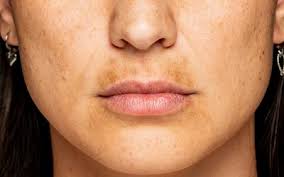 what is a melasma mustache and how do i
