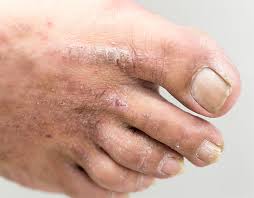 atopic dermais eczema treatments