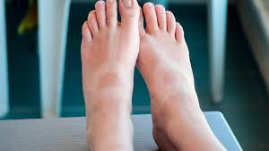 swollen feet from sunburn home