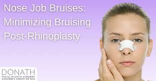 minimize bruising after nose job 8