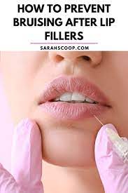prevent bruising after lip fillers