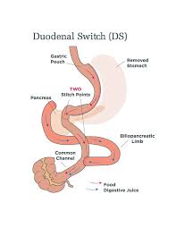 duodenal switch procedures sadi s and