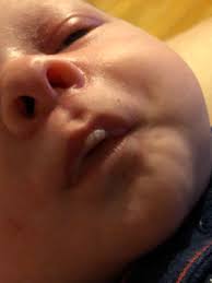 newborn swollen blistered lips after
