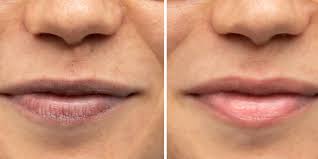 dark lip lightening treatment in noida