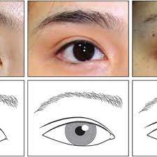 three typical types of double eyelid