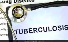 Tuberculosis Treatment 8 Foods That Can Help You Recover Faster