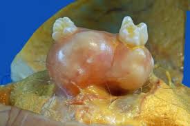 benign teratoma of the ovary 2