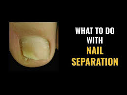 nail separation what to do and what