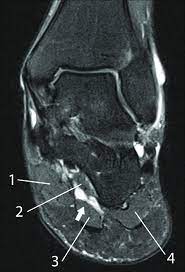 By muhammad ali, mb bs; Mri Of The Left Foot In A Normal Patient For Comparison Coronal Download Scientific Diagram