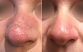 vbeam rosacea treatment before and