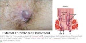 Patients often don't realize they have an internal hemorrhoid unless there is the presence of blood. Your Top 10 Questions About Hemorrhoids Answered Dr Cedrek Mcfadden