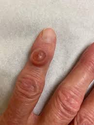 orthodx cyst on index finger