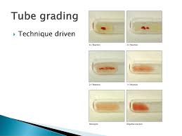 Grading Agglutination Ppt Download