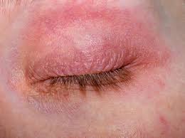 rash around eyes causes symptoms and