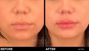 fillers for the face aesthetic center