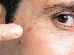 common dark spots on the face