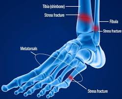 Image result for stress fracture army