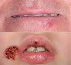 cold sore on lip causes prevention
