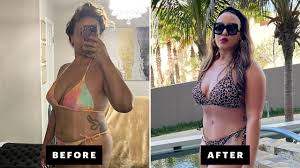 liposuction and a tummy tuck