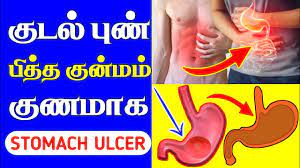 stomach ulcer natural remedy