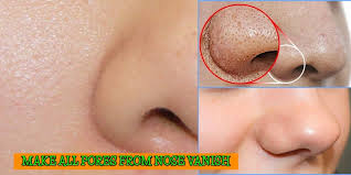 How to, nose pore strips, nose strips, skin, skin care. 8 Effective Ways To Close Pores On Nose Makeupandbeauty Com
