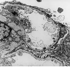 Electron Micrograph Of Renal Biopsy